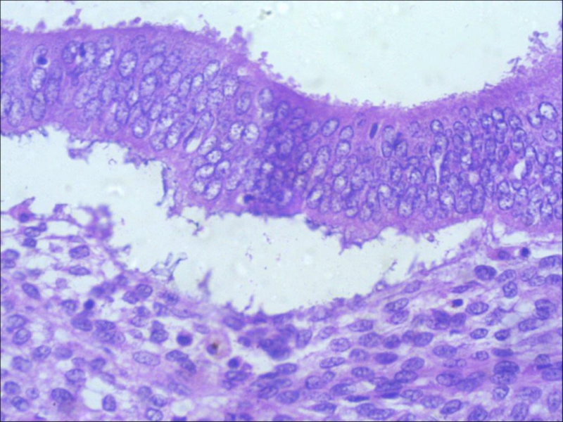 Primary umbilical endometriosis with menstruation from the umbilicus: a ...