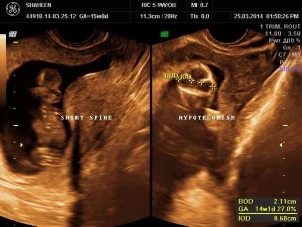 Antenatal ultrasound diagnosis of ‘Iniencephaly Apertus’ – ISGE