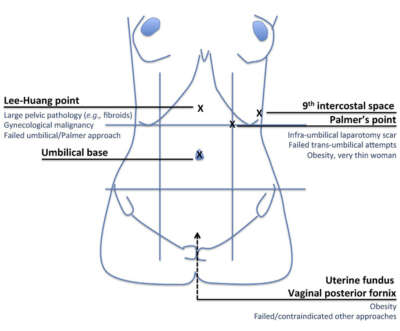 Principles of safe laparoscopic entry: a summary of the International ...