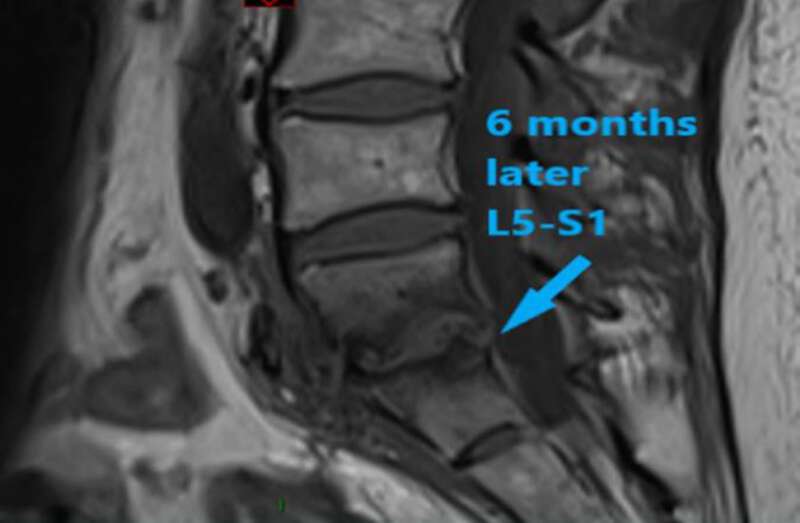 Case report on complications of Laparoscopic Sacrohysteropexy- Non ...