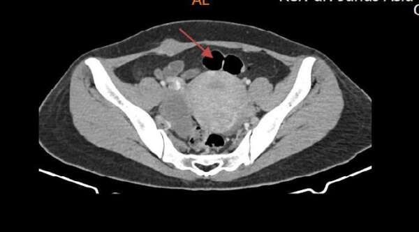 ENDOMETRIOSIS OF THE RECTUS ABDOMINIS MUSCLE FOLLOWING A CAESAREAN ...