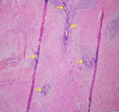 ENDOMETRIOSIS OF THE RECTUS ABDOMINIS MUSCLE FOLLOWING A CAESAREAN ...