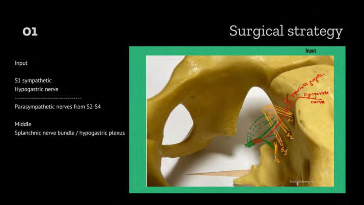 Laparoscopic Nerve Sparing Radical Hysterectomy Without Uterine Manipulator In Persistent